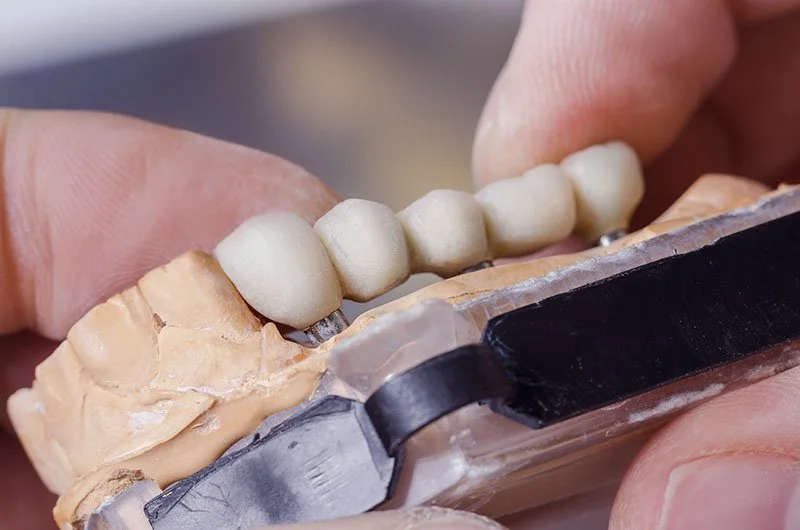 Types of Dental Bridges