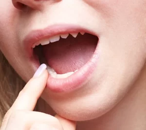 Understanding Wisdom Teeth image