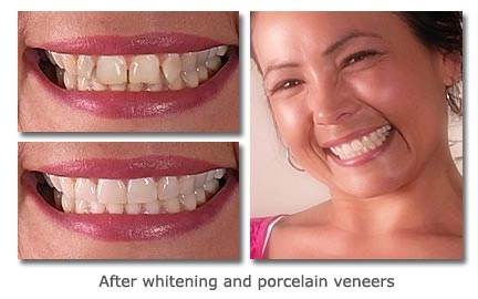 After whitening and porcelain veneers