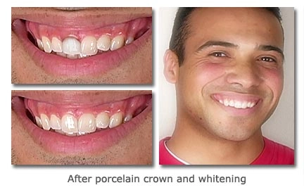 After porecelain crown and whitening