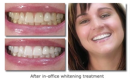 After in-office whitening treatment