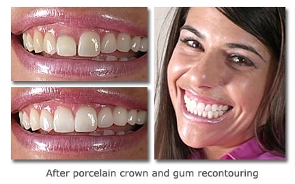 After porcelain crown and gum recontouring