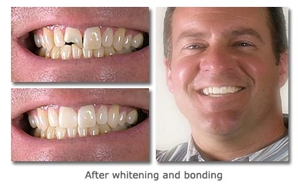 After whitening and bonding